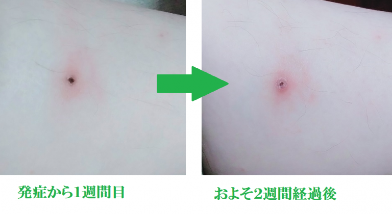 ダニ(ツメダニ)刺されアレルギーで炎症!?長引く痒みと治るまでの経過記